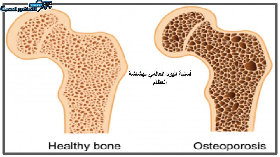 أسئلة اليوم العالمي لهشاشة العظام